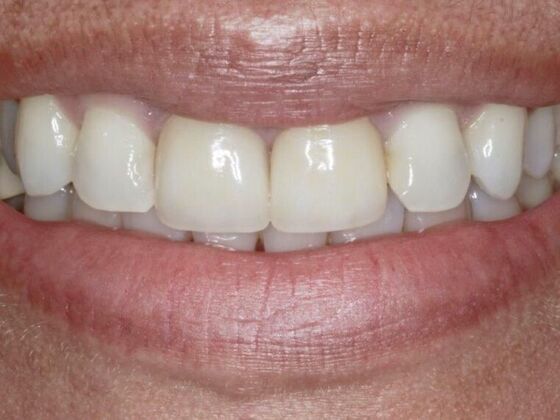 Smile Makeover & Veneers: Tina - Before