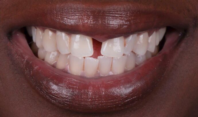 Dr. Wayne Myles' patient before veneers