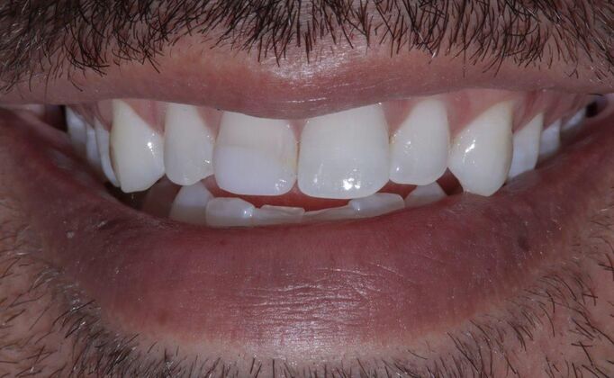 Smile Makeover & Veneers: Tom - Before