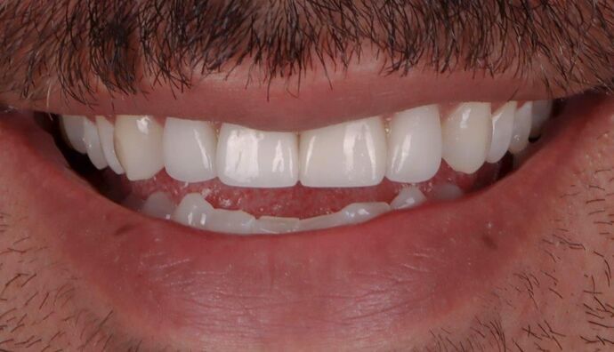 Smile Makeover & Veneers: Tom - After