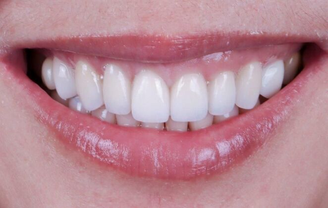 Smile Makeover & Veneers Cindy