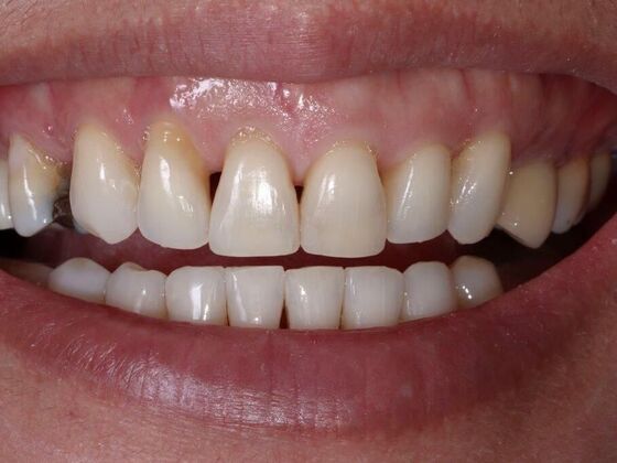 Smile Makeover & Veneers: Cindy - Before