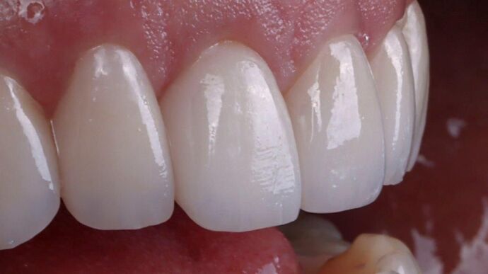 Smile Makeover & Veneers: Cindy - After