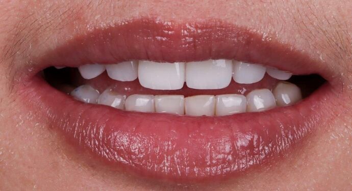 Smile Makeover & Veneers: Cindy - After