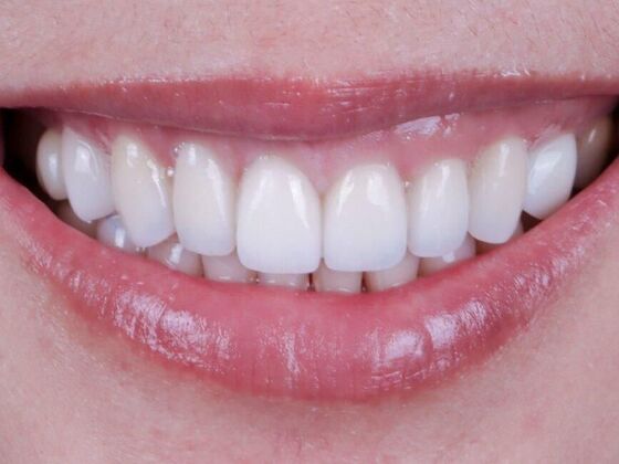 Smile Makeover & Veneers: Cindy - After