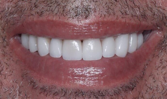 Smile Makeover & Veneers James