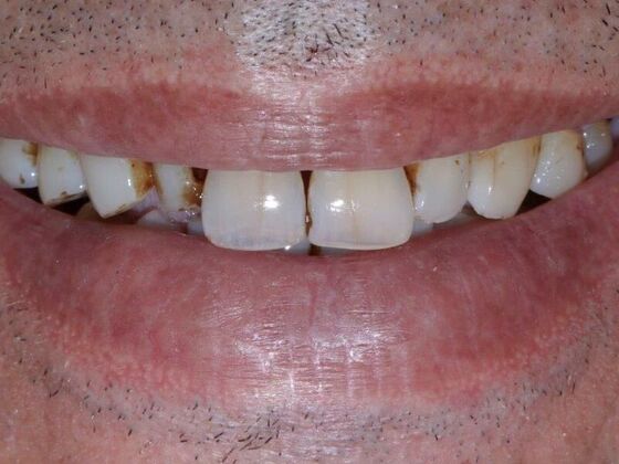 Smile Makeover & Veneers: James - Before