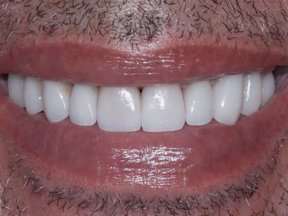 Smile Makeover & Veneers: James - After