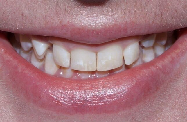 Smile Makeover & Veneers: Cynthia - Before