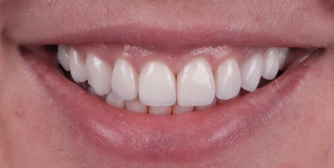 Smile Makeover & Veneers: Cynthia - After