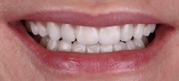 Smile Makeover & Veneers Olivia