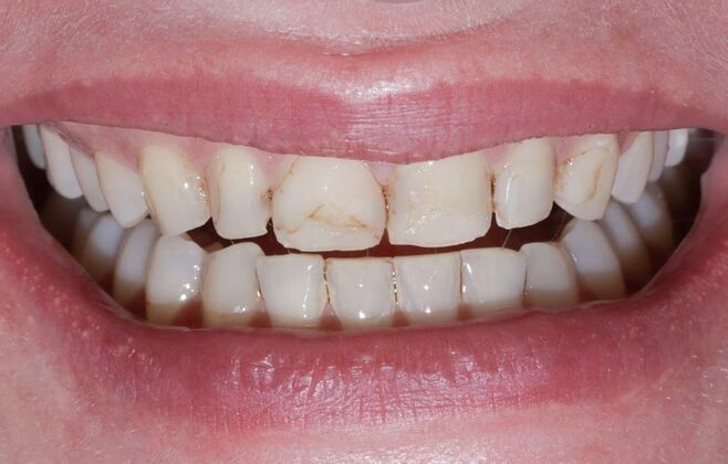 Smile Makeover & Veneers: Olivia - Before