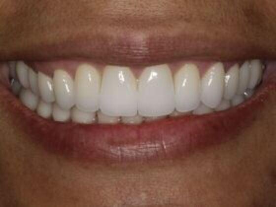 Smile Makeover & Veneers Case 1
