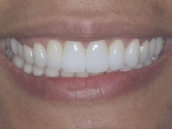 Smile Makeover & Veneers: Case 1