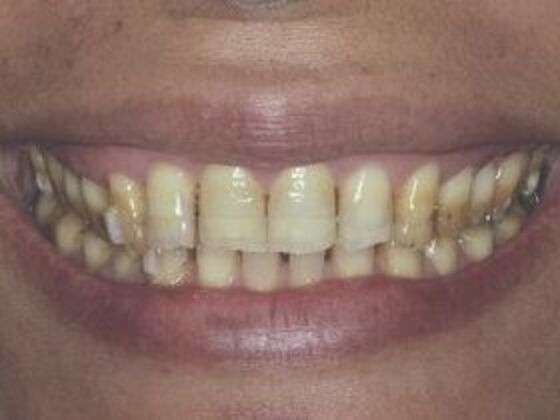 Smile Makeover & Veneers: Case 1