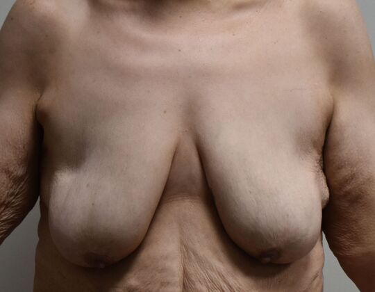 Breast Augmentation w/ Lift Case 562 - Before