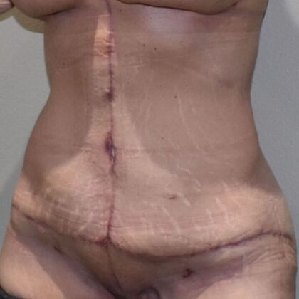 Tummy Tuck (Abdominoplasty): Case 510 - After