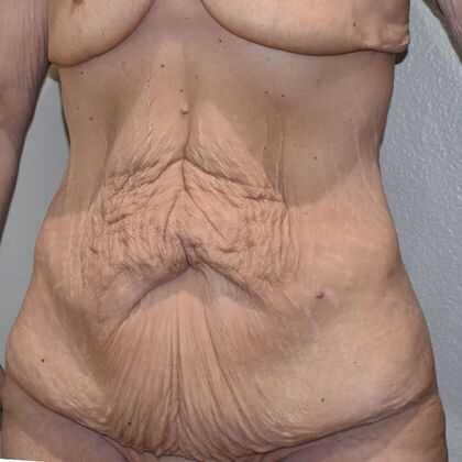 Tummy Tuck (Abdominoplasty): Case 510 - Before