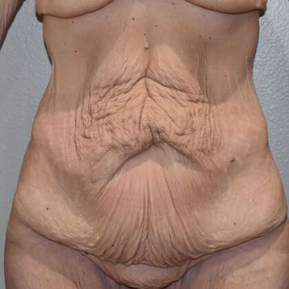 Massive Weight Loss : Case 161 - Before