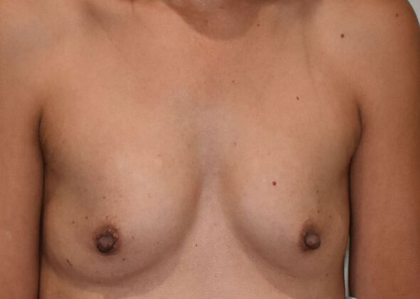Breast Augmentation Case 777 - Before
