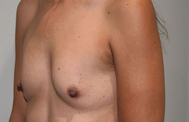 Breast Augmentation: Case 777 - Before