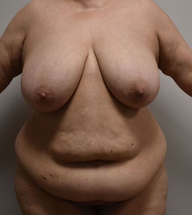 Massive Weight Loss : Case 162 - Before