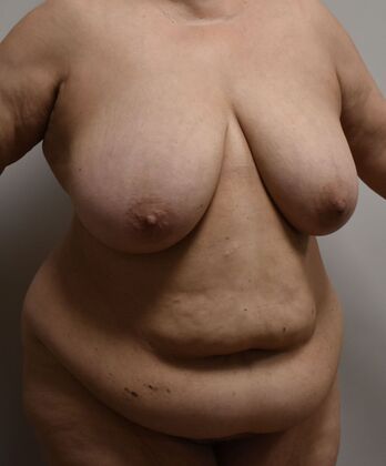 Massive Weight Loss : Case 162 - Before