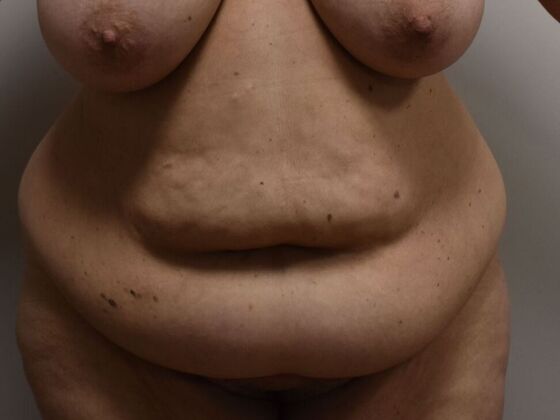 Tummy Tuck (Abdominoplasty): Case 511 - Before