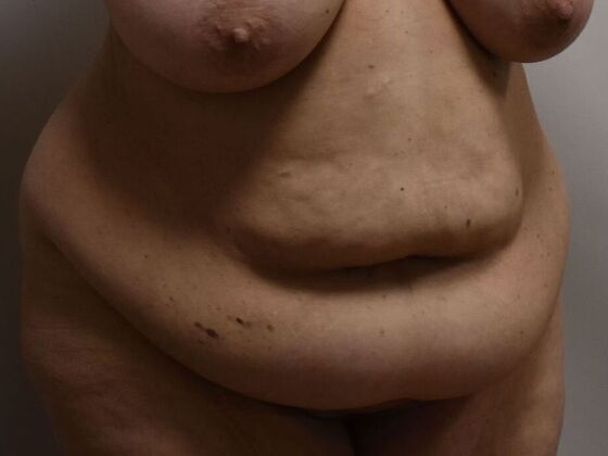 Tummy Tuck (Abdominoplasty): Case 511 - Before