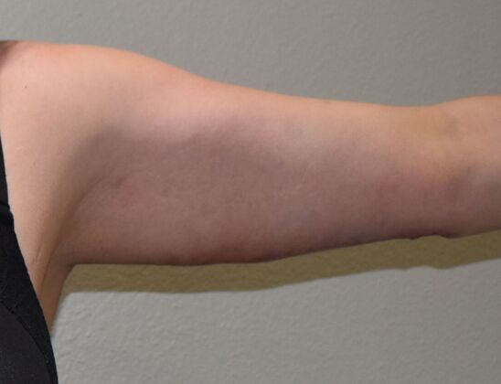 Brachioplasty Case 22 - After