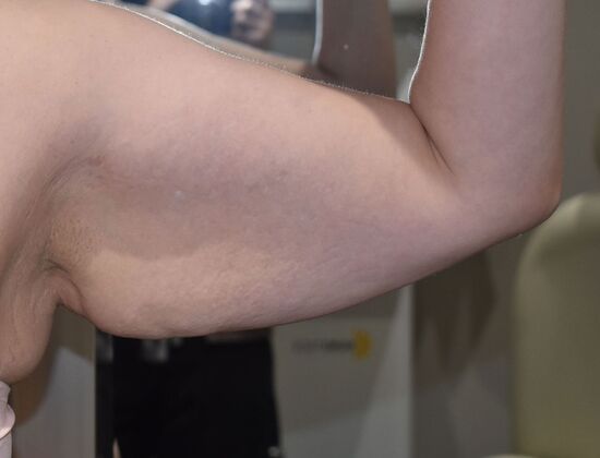 Brachioplasty Case 22 - Before