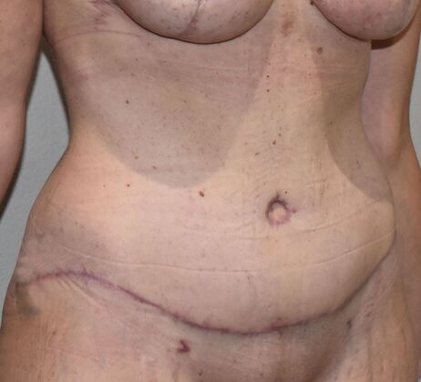 Tummy Tuck (Abdominoplasty): Case 488 - After