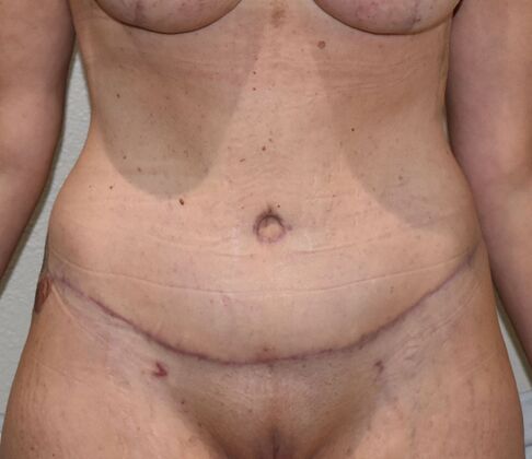Tummy Tuck (Abdominoplasty): Case 488 - After