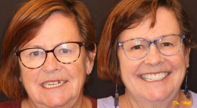 Dental Implants Case 1