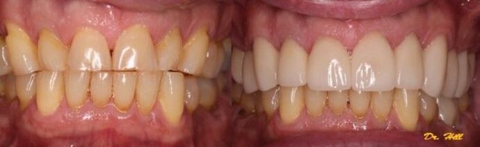 Smile Makeover Case 1