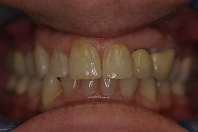 Dental Crowns Case 1 - Before