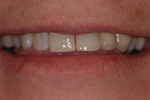 Dental Crowns Cases