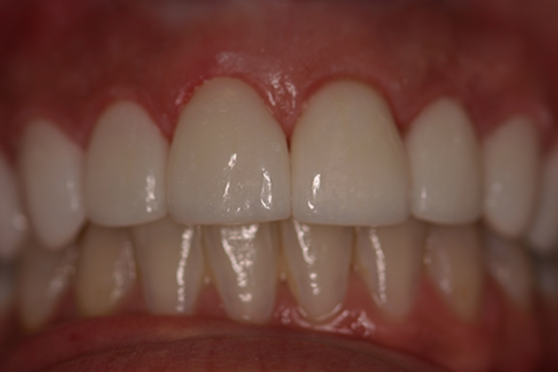 Dental Crowns Case 2 - After