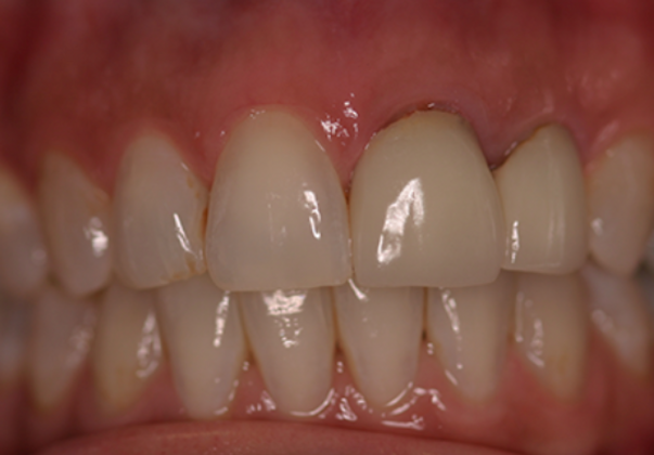 Dental Crowns Case 2 - Before