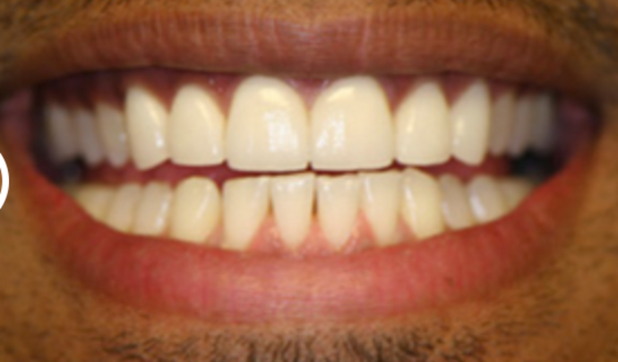 Dental Crowns Case 3 - After