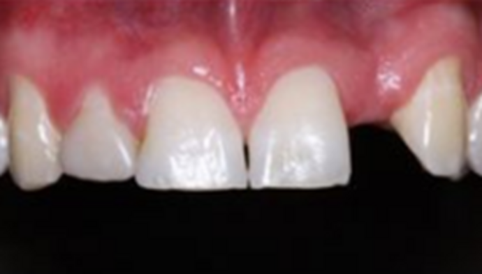 Dental Crowns Case 4 - Before