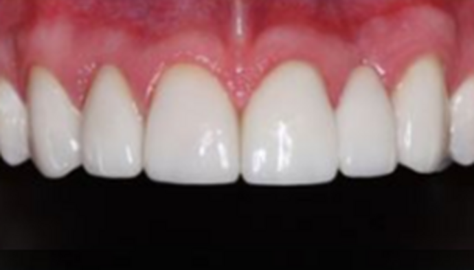 Dental Crowns Case 4 - After