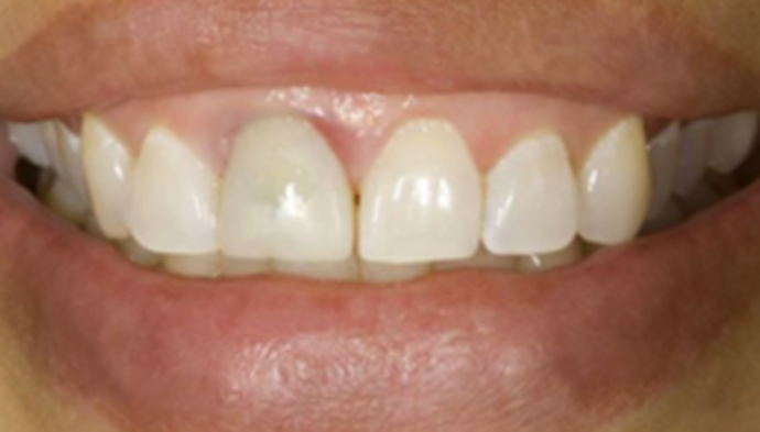 Dental Crowns Case 5 - Before