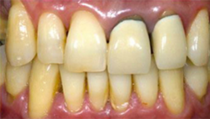 Dental Crowns Case 6 - Before