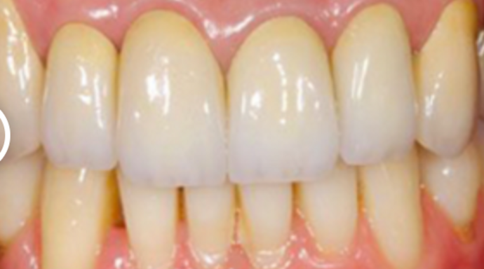 Dental Crowns Case 6 - After