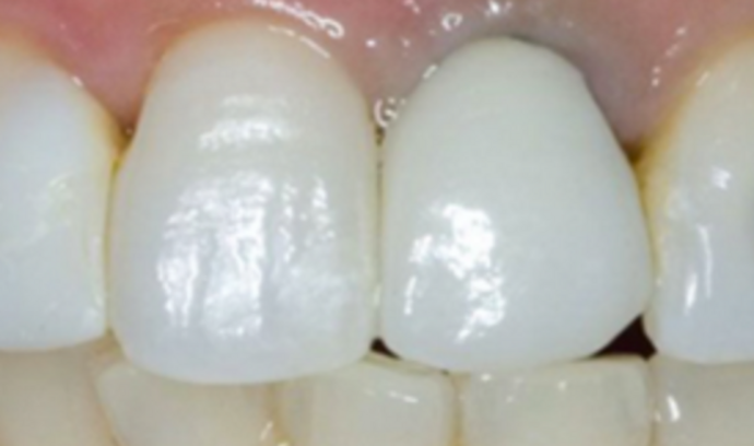 Dental Crowns Case 7 - Before