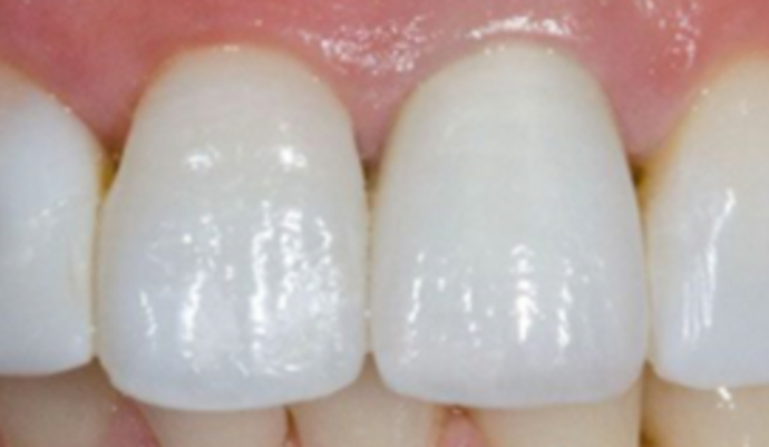 Dental Crowns Case 7 - After