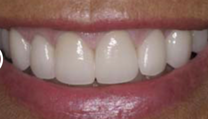Dental Crowns Case 8 - Before