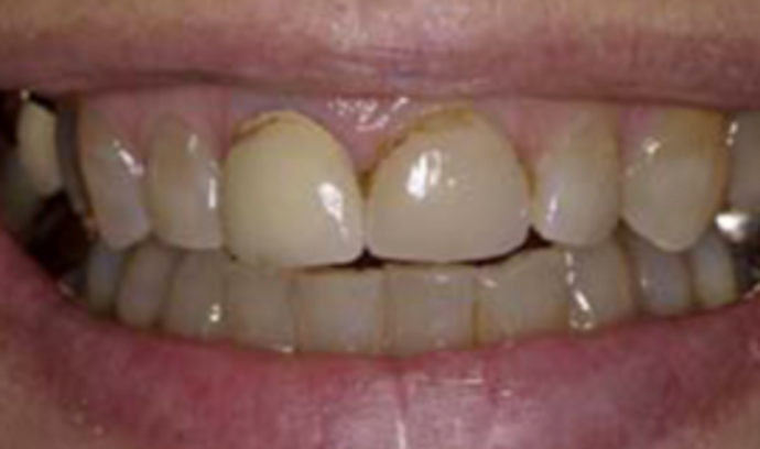 Dental Crowns Case 8 - After