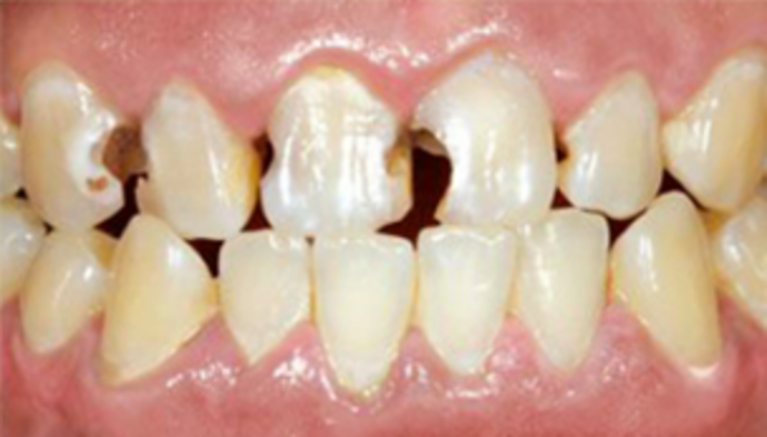 Dental Crowns Case 9 - Before